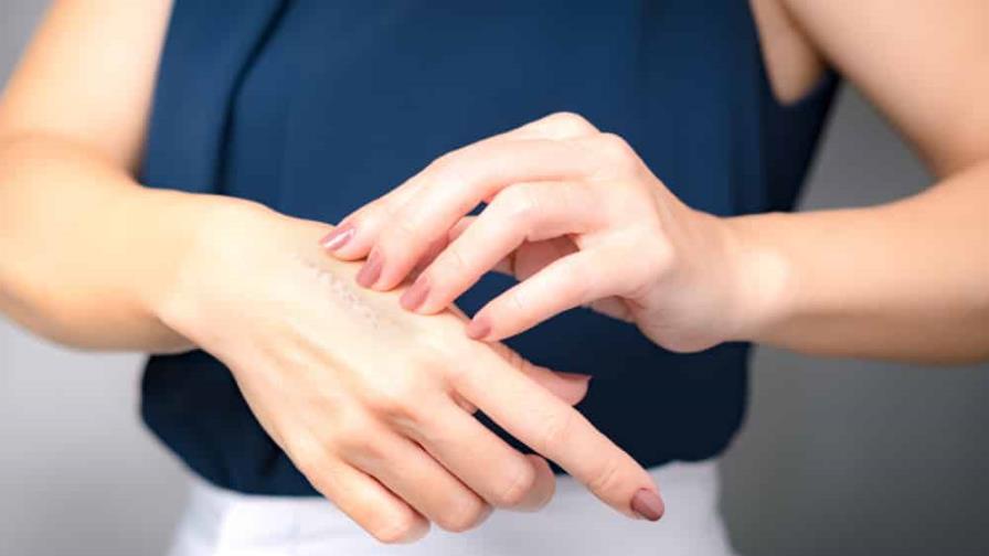 Quemaduras: ¿cómo afectan la piel?