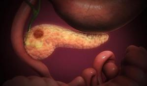 Una de cada seis personas con cáncer de páncreas tiene mutaciones genéticas hereditarias