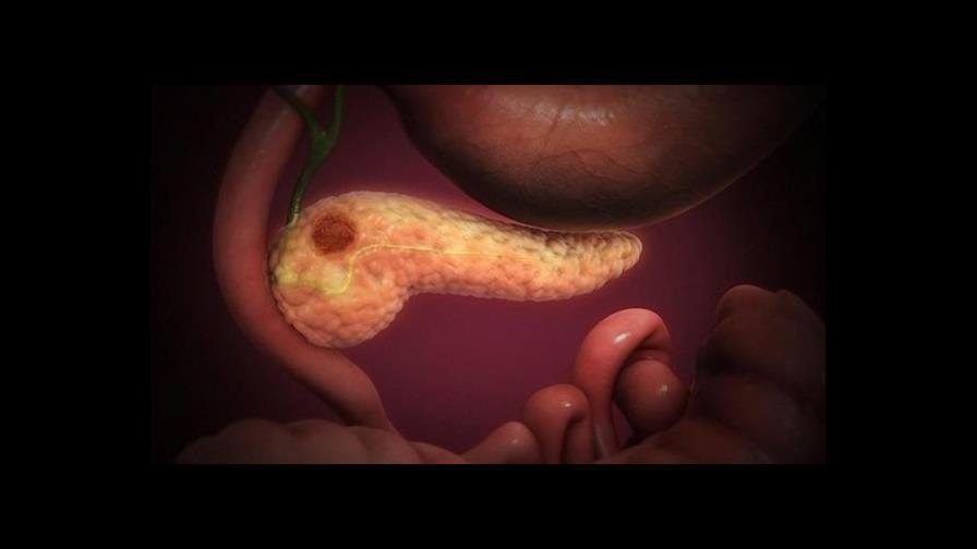 Una de cada seis personas con cáncer de páncreas tiene mutaciones genéticas hereditarias Una de cada seis personas con cáncer de páncreas tiene mutaciones genéticas hereditarias