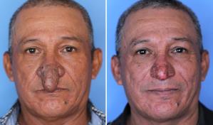 “Dios envió un ángel”: Hombre de Nueva York con deformidad severa obtiene una nueva nariz para Navidad