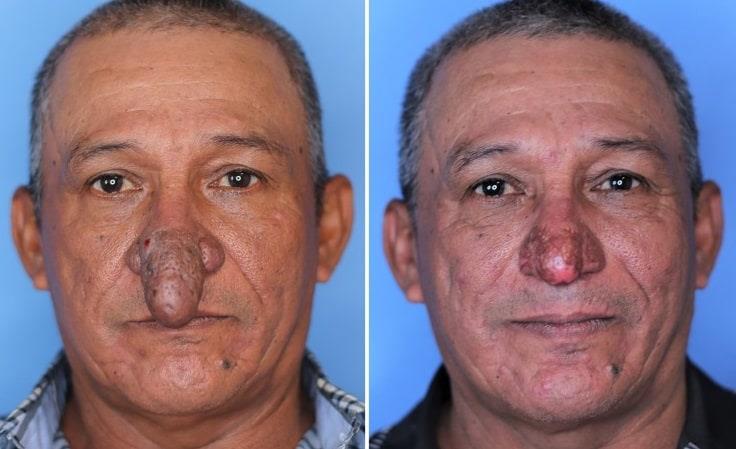“Dios envió un ángel”: Hombre de Nueva York con deformidad severa obtiene una nueva nariz para Navidad