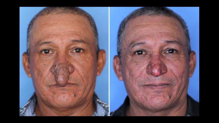 “Dios envió un ángel”: Hombre de Nueva York con deformidad severa obtiene una nueva nariz para Navidad “Dios envió un ángel”: Hombre de Nueva York con deformidad severa obtiene una nueva nariz para Navidad