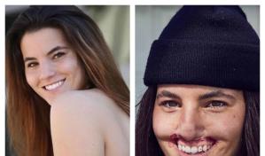 La dura historia de la modelo que perdió labio superior por el ataque de un perro