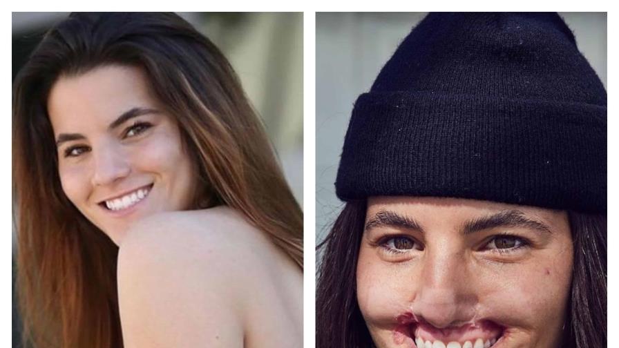 La dura historia de la modelo que perdió labio superior por el ataque de un perro