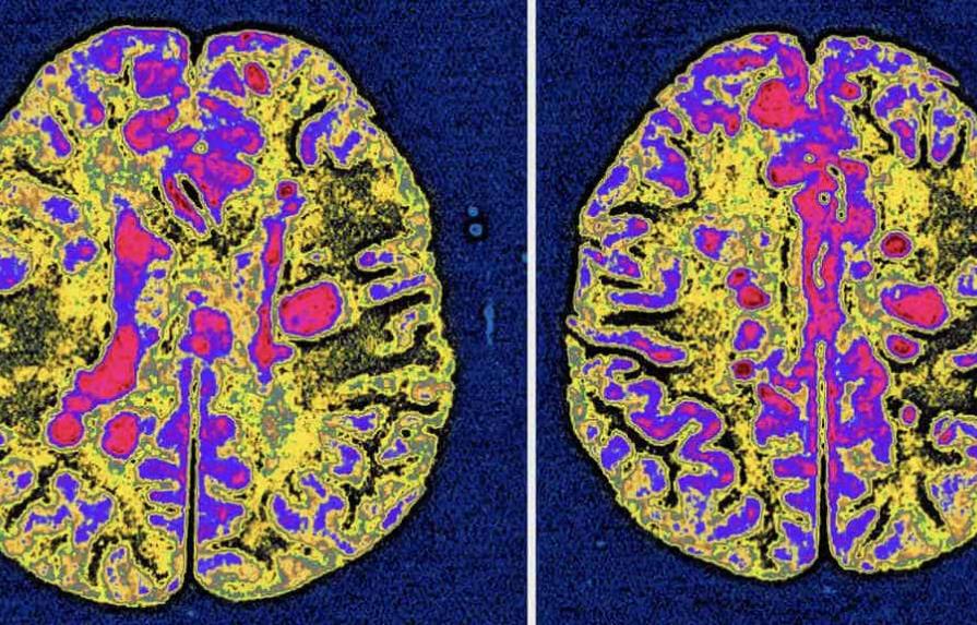 El virus de Epstein-Barr podría ser causa principal de la esclerosis múltiple