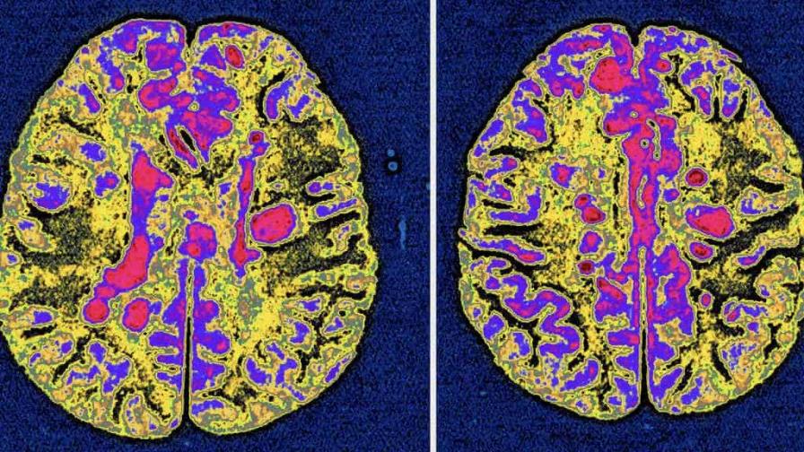 El virus de Epstein-Barr podría ser causa principal de la esclerosis múltiple El virus de Epstein-Barr podría ser causa principal de la esclerosis múltiple