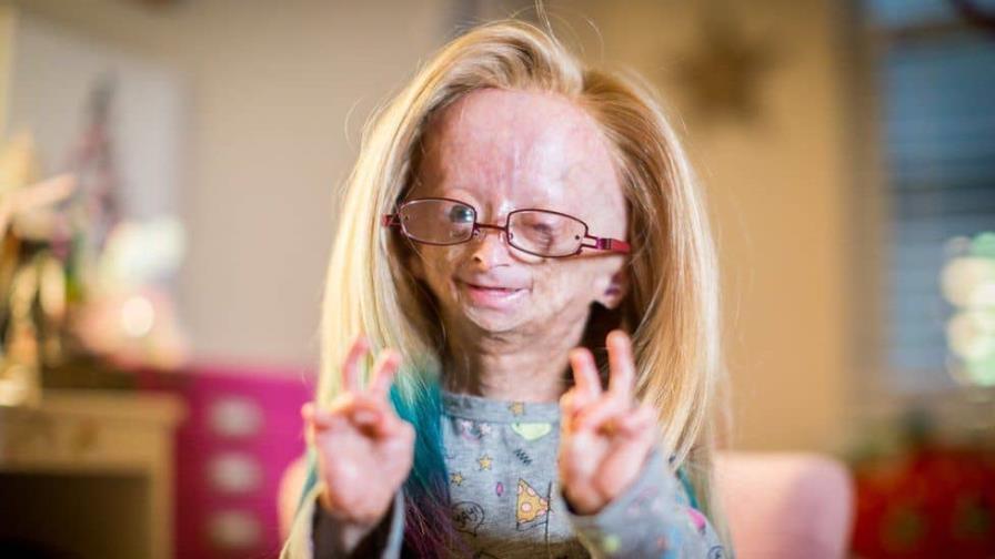 Muere con 15 años Adalia Rose, la youtuber que no paraba de envejecer