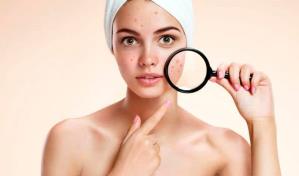 Estos hábitos diarios incrementan el acné