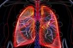 Analizan si enfermos con neumonía por COVID-19 desarrollan fibrosis pulmonar