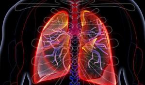 Analizan si enfermos con neumon&iacute;a por COVID-19 desarrollan fibrosis pulmonar