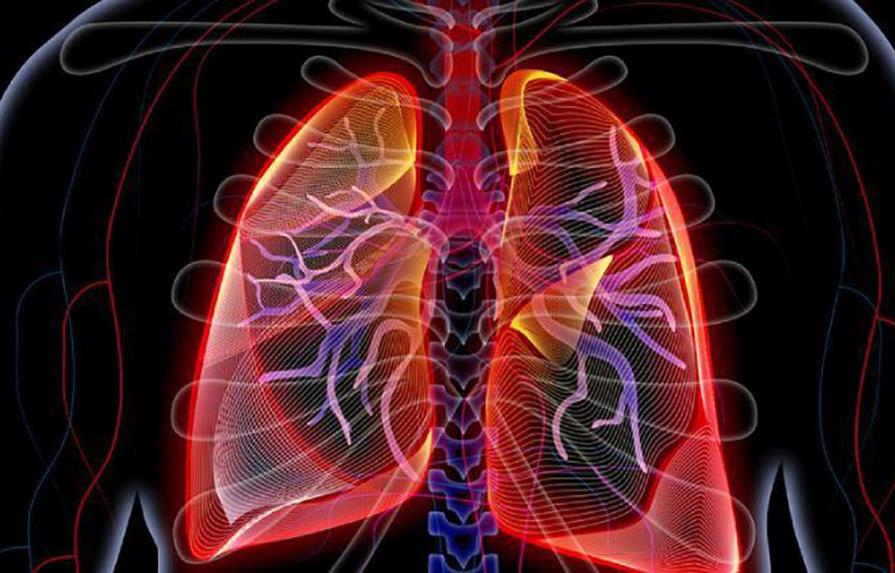 Analizan si enfermos con neumonía por COVID-19 desarrollan fibrosis pulmonar