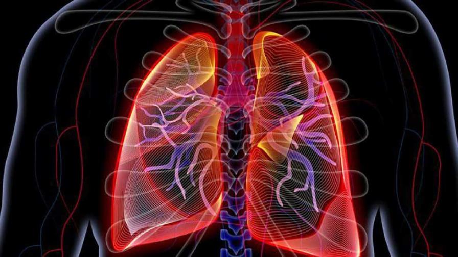 Analizan si enfermos con neumonía por COVID-19 desarrollan fibrosis pulmonar Analizan si enfermos con neumonía por COVID-19 desarrollan fibrosis pulmonar
