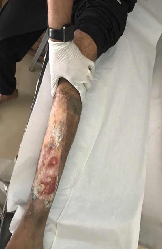 Un preso con una enfermedad en un recinto carcelario 