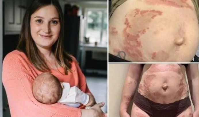 Mujer en Inglaterra era alérgica a su propio hijo