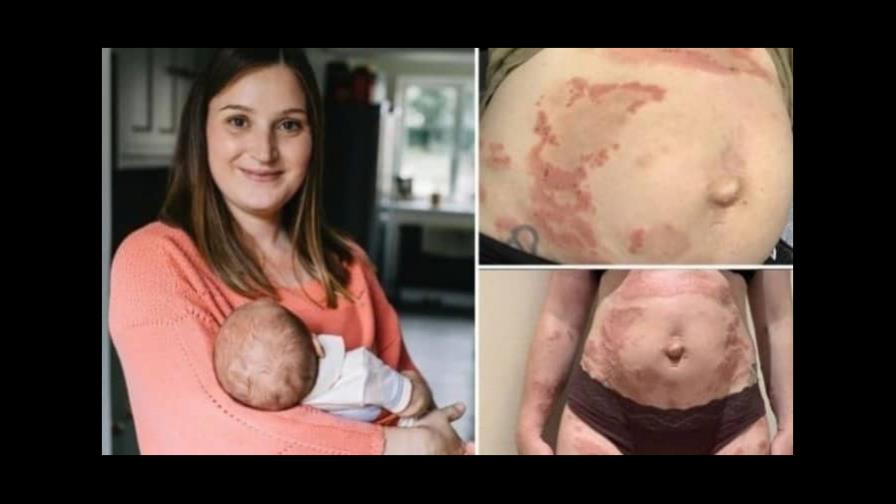 Mujer en Inglaterra era alérgica a su propio hijo