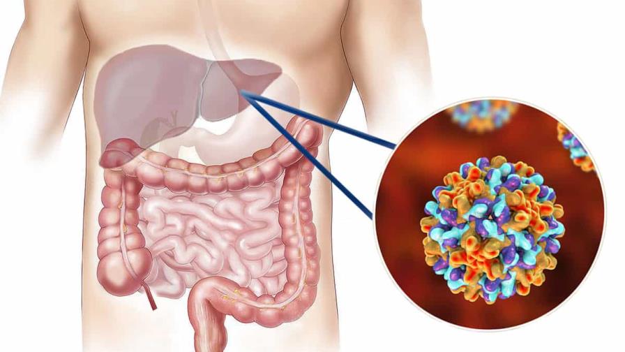 Pacientes con hepatitis C pueden durar hasta 20 años asintomáticos