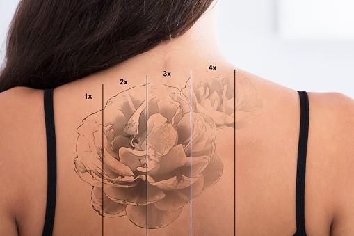 Tres opciones para borrar un tatuaje
