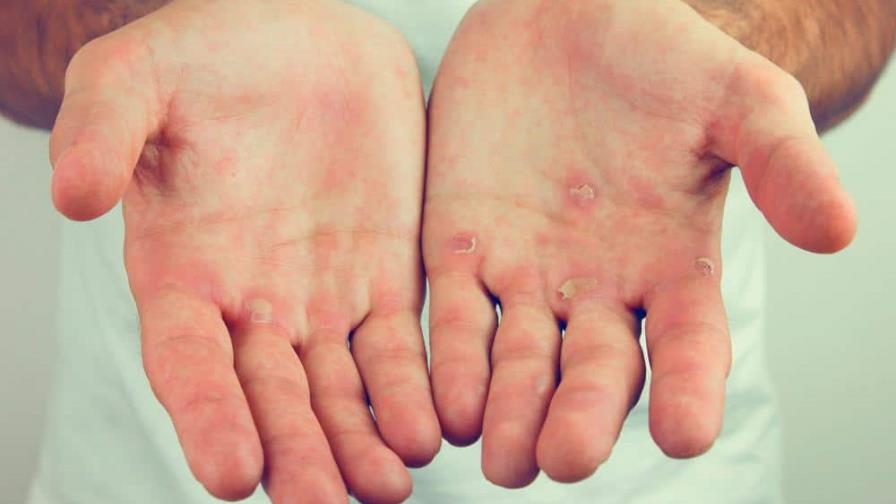 Por esta razón te salen callos en las manos