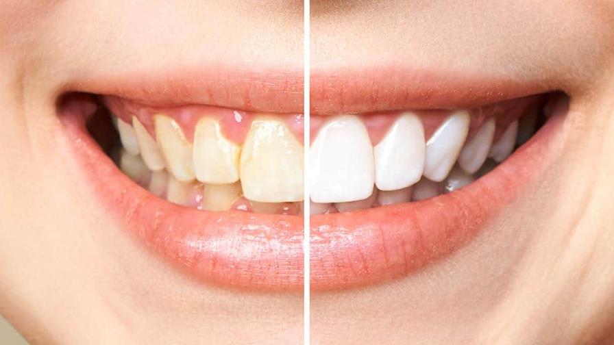 La mejor manera de evitar las manchas dentales La mejor manera de evitar las manchas dentales