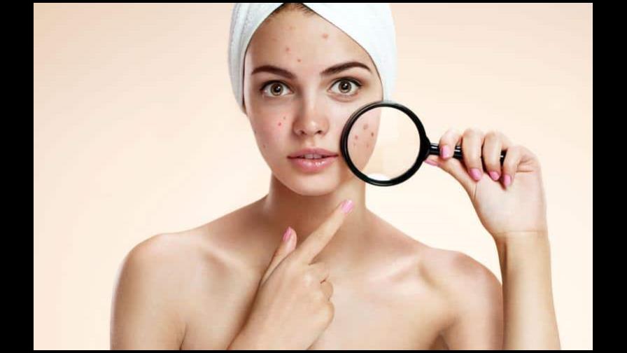 Estos hábitos diarios incrementan las probabilidades de tener acné