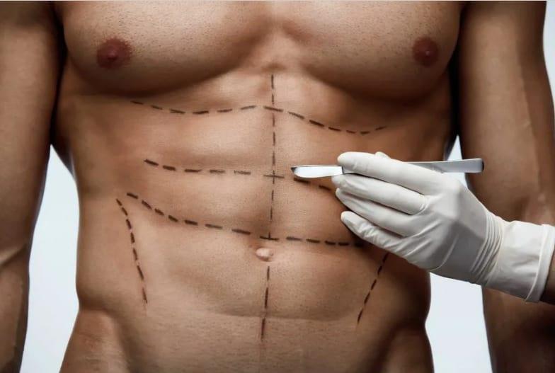 Marcación abdominal, la cirugía estética de moda para lucir cuadritos
