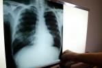 República Dominicana registró más de tres mil casos de tuberculosis en 2021