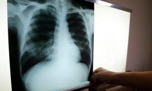 República Dominicana registró más de tres mil casos de tuberculosis en 2021