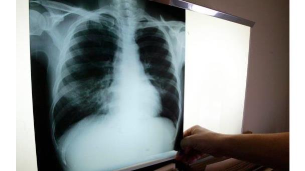República Dominicana registró más de tres mil casos de tuberculosis en 2021