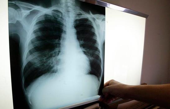 República Dominicana registró más de tres mil casos de tuberculosis en 2021