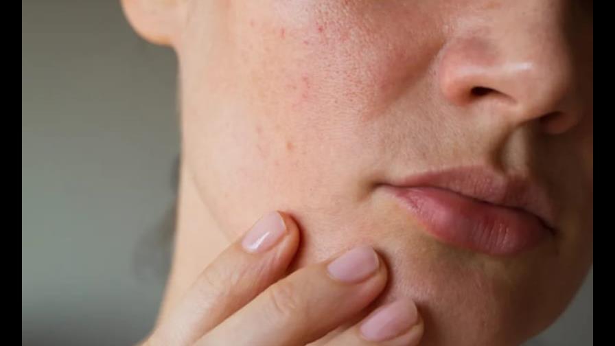 Piel grasa: las dudas más frecuentes