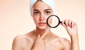 Acné: cómo evitarlo