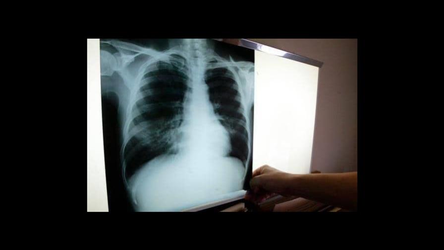 De 5 casos de tuberculosis en El Seibo 1 es un recluso