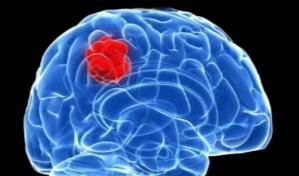 Descubren utilidad de f&aacute;rmacos para la hipertensi&oacute;n para un c&aacute;ncer cerebral