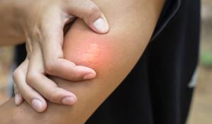 Picaduras de insectos: cómo tratarlas