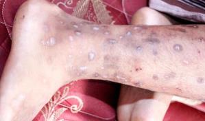 &iquest;En qu&eacute; consiste la enfermedad contagiosa que afecta Hait&iacute;?