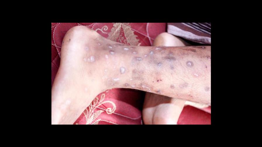 ¿En qué consiste la enfermedad contagiosa que afecta Haití?