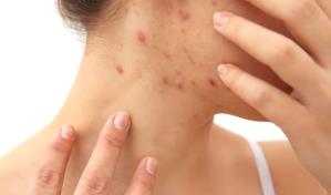 Sociedad Dominicana de Dermatolog&iacute;a llama a no alarmarse ante enfermedad cut&aacute;nea en Hait&iacute;