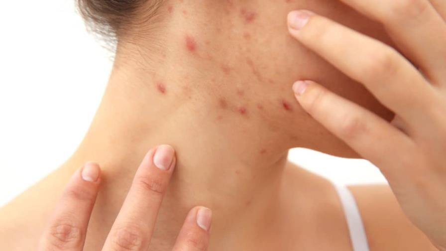 Sociedad Dominicana de Dermatología llama a no alarmarse ante enfermedad cutánea en Haití