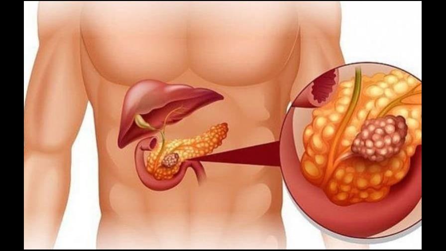 Un virus modificado genéticamente ayuda a combatir cáncer páncreas avanzado Un virus modificado genéticamente ayuda a combatir cáncer páncreas avanzado