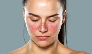 Lupus, una enfermedad autoinmune que ataca tejidos sanos