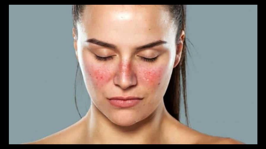 Lupus, una enfermedad autoinmune que ataca tejidos sanos Lupus, una enfermedad autoinmune que ataca tejidos sanos