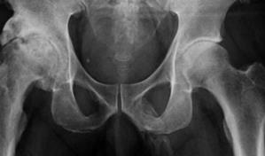 Incre&iacute;ble: el pene de este hombre se est&aacute; convirtiendo en hueso