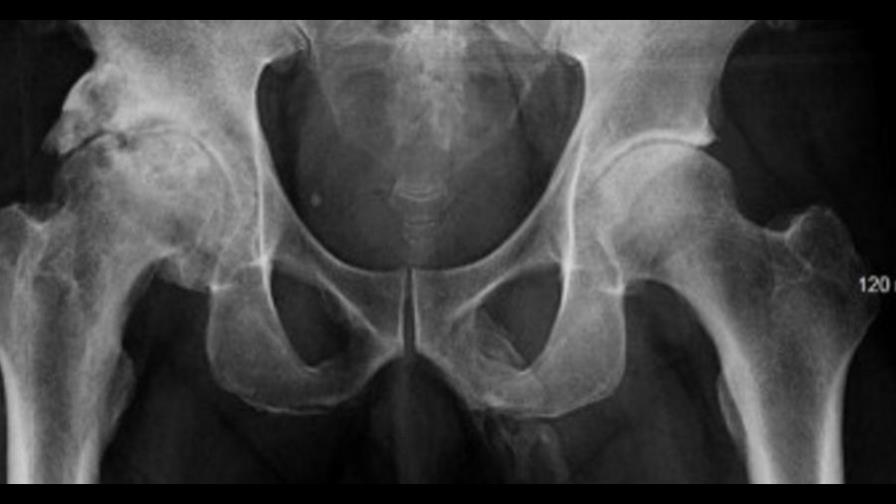 Increíble: el pene de este hombre se está convirtiendo en hueso