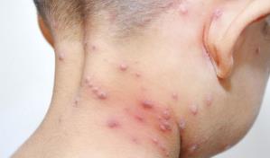 San Francisco declara emergencia por brote de viruela símica