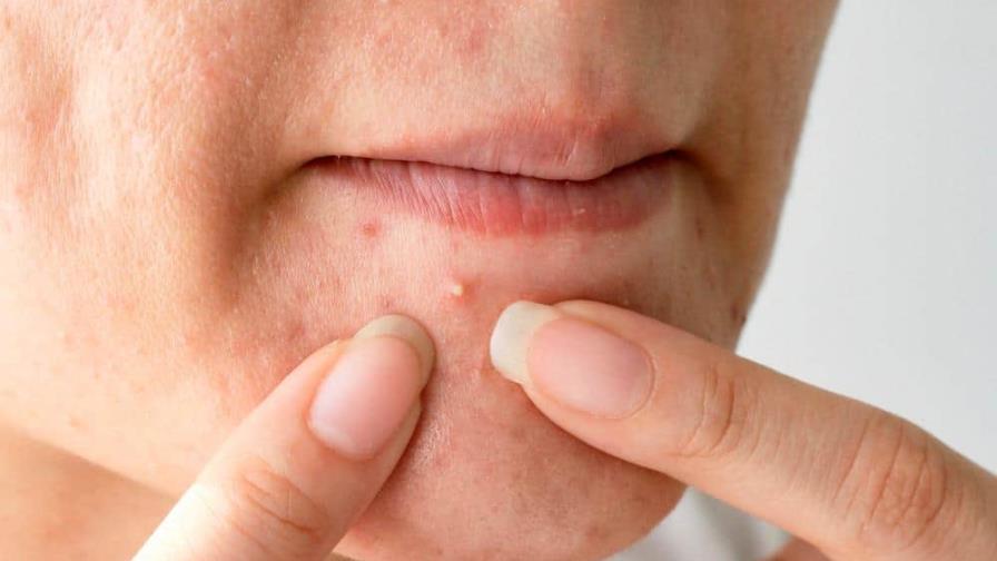 Logran reducir las cepas de las bacterias de la piel que causan el acné Logran reducir las cepas de las bacterias de la piel que causan el acné