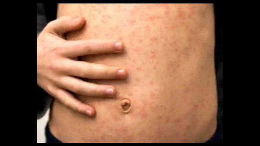 Salud Pública emite alerta por viruela del mono; aun no hay casos en el país Salud Pública emite alerta por viruela del mono; aun no hay casos en el país