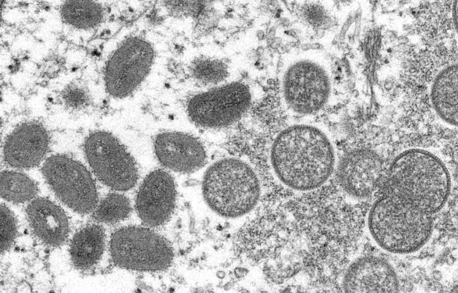 Departamento de Salud investiga posible caso de viruela símica en Nueva York
