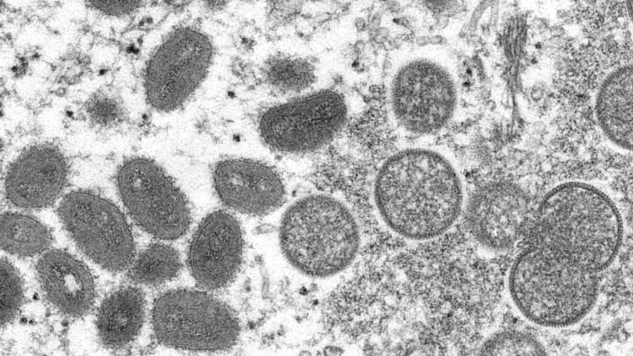 Departamento de Salud investiga posible caso de viruela símica en Nueva York Departamento de Salud investiga posible caso de viruela símica en Nueva York