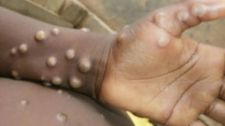 Francia y Alemania confirman sus primeros casos de viruela del mono Francia y Alemania confirman sus primeros casos de viruela del mono