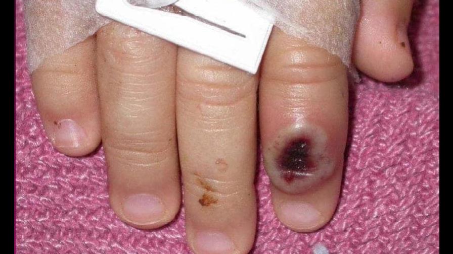 La Academia de Medicina pide calma a los venezolanos ante la viruela del mono